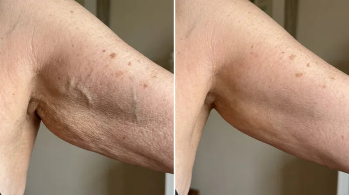 Before and after arm results