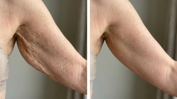 Before and after arm results